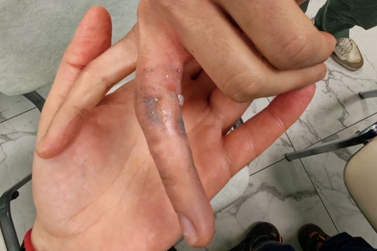 Спасатели ПСЧ‑244 в Одинцовском округе освободили палец подростка из кресла